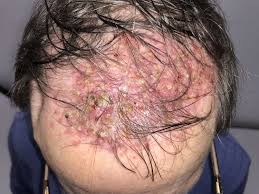 Image result for Tinea Capitis