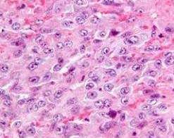 Check spelling or type a new query. Mesothelioma Oncology Medbullets Step 1