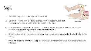 Image result for Psoas Sign