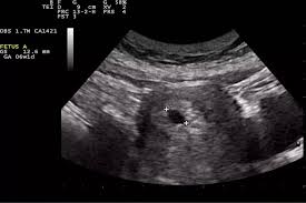 El catálogo de ultrasonido cardiovascular de esaote incluye una amplia selección de productos, desde sistemas de consola hasta unidades portátiles de rendimiento superior. Ultrasonido En El Primer Trimestre Del Embarazo 10 Consideraciones Basicas