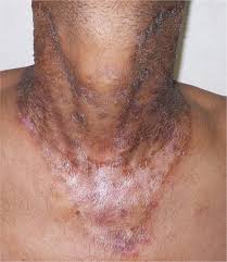 Image result for Photodermatitis