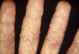 While black fungus starts off with distinct facial disfiguration, the yellow fungus infection starts to cause symptoms by launching an attack on the body's internal organ, and disturbing vital. Ringworm Of The Hand Picture Image On Medicinenet Com