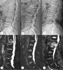 Image result for Vertebral Compression Fracture