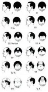 Hair thinning occurs for all the hair strands over the scalp area. Early Signs Of Hair Loss In Men And Women