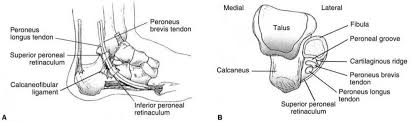 Retinal holes are typically smaller and have a lower risk for causing a retinal detachment. Peroneal Tendon Tears And Instability Foot Ankle Orthobullets