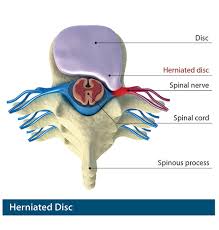 With va video connect on a desktop, smartphone or tablet, veterans can participate in video. Herniated Disc Treatment Spine Group Alabama