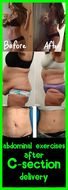 Abdominal Exercises After C Section Delivery Abdominalexcersise After C Section Workout C Section Workout Diastasis Recti Exercises