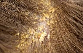 Maybe you would like to learn more about one of these? Wet Dandruff What Is It And How To Treat It 5 Home Remedies