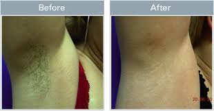 Find deals on products in hair removal on amazon. Why Do My Armpits Hurt After Waxing