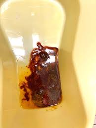 Image result for Blood in stool