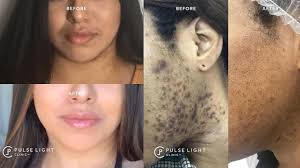 With treatment, most women with pcos are able to get pregnant. Pcos Facial Hair Growth And Laser Hair Removal Youtube