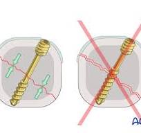 Headless compression screw insertion