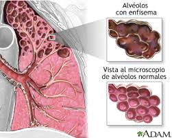 Es una enfermedad del sistema respiratorio que consiste en la inflamación de los espacios alveolares de los pulmones. Enfermedad Pulmonar Obstructiva Cronica Epoc Medlineplus Enciclopedia Medica