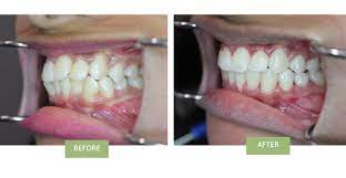 In addition to using invisalign bite correction, fixing a crossbite might require the use of an additional orthodontic appliance like a palatal expander. Invisalign For Crossbite Can Invisalign Fix Crossbite