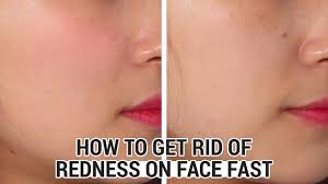 Find how to get rid of roches on theanswerhub.com. How To Get Rid Of Redness On Face Fast Klairs Midnight Blue Calming Cream Youtube