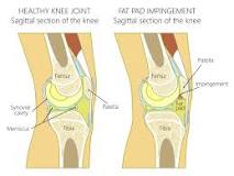 Image result for icd 10 code for right knee fat pad impingement