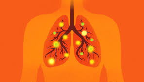 Image result for Pneumonia