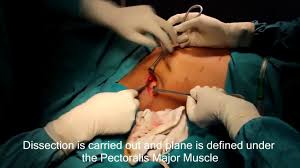 We did not find results for: Male To Female Transgender Surgery Videos Sex Change Surgery Video