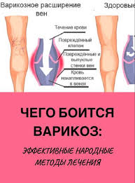 как избавиться от целлюлита при варикозе в домашних условиях Pin Na Doske Zdorove I Sport