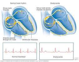Bradycardia Symptoms And Causes Mayo Clinic Vagus Nerve Symptoms