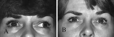 The Efficacy Of Strabismus Surgery In Adults A Review For Primary Care Physicians Postgraduate Medical Journal