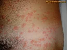 Image result for Trombicula autumnalis bites