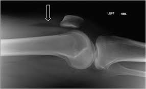 Image result for Knee XRay