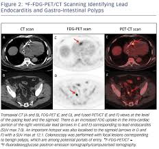 Pet scans to diagnose cancer and assess cancer treatment; Infective Endocarditis Fdg Pet Scan Diagnostic Accuracy