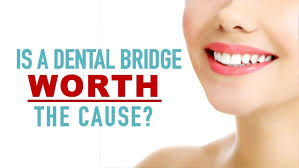 What is the best bridge for teeth? Is A Dental Bridge Worth The Cost