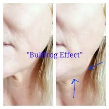 Maybe you would like to learn more about one of these? Follow Up Question Regarding Full Face Botox Bullfrog Effect Under Chin Photo