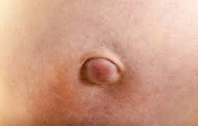 Image result for Inguinal hernia child