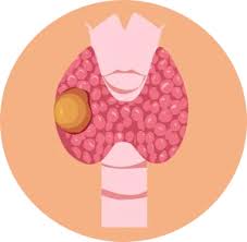 Image result for Nodule