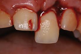 Image result for Tooth Luxation
