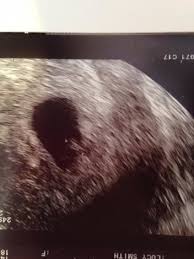7 weeks 6 days ultrasound w heartbeat youtube. Overweight Worried About Ultrasound Scans