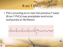 Ventricular Dysrhythmias Ppt Download