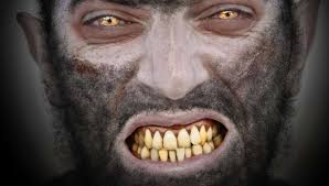Hypertrichosis has informally been called werewolf syndrome 13. Werewolf Syndrome Congenital Hypertrichosis Lanuginosa Medical Bag