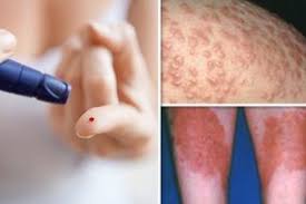 Pin On Diabetic