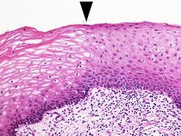 Common sites for squamous metaplasia include the bladder and cervix. Pathology Outlines Squamous Metaplasia