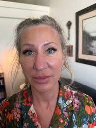 72 hours post op lower face lift and C02 laser