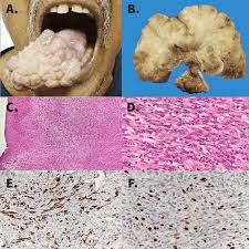 Image result for spinocellular carcinoma of the oral cavity