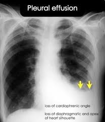 Many different types of conditions can cause pleural effusions, with heart failure and pneumonia among the more common ones. Which Of The Following Diagnoses Should Be Considered When An Unexplained Isolated Pleural Effusion Is Found On Ch Radiology Imaging Pleural Effusion Radiology