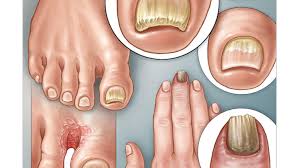 Image result for mykoza nehtů