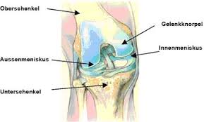 Innerer und äußerer meniskus im kniegelenk sind halbmondförmige knorpel, die im gelenk zwischen schienbeinkopf und oberschenkelknochen eingebettet sind. Beschwerden Am Knie