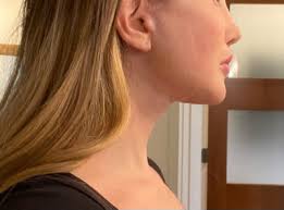 Revision face and neck Lift w/ fat transfer