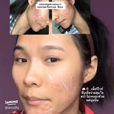When acne is "used" or "not used," Moyce?