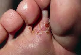 A flaky and scaly rash may then there are four different types of fungus that can cause athlete's foot although the most common is. Picture Of Ringworm Of The Foot Tinea Pedis