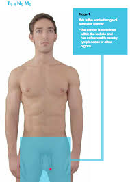 Testicular cancer is the most common cancer in young men between the ages of 15 and 35, but the disease also occurs in other age groups, so all men should be aware of its symptoms. Orchid Results