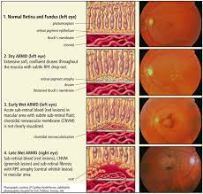 Classification Of Armd Eye Facts Eye Health Macular Degeneration