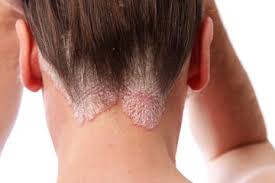 Image result for sores on the head in children