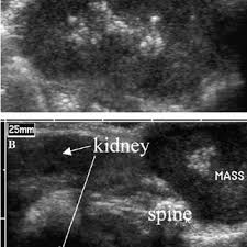 Nccn clinical practice guidelines in oncology. B Mode Ultrasound Images Of Mda Mb231 Human Breast Cancer Tumors In Download Scientific Diagram